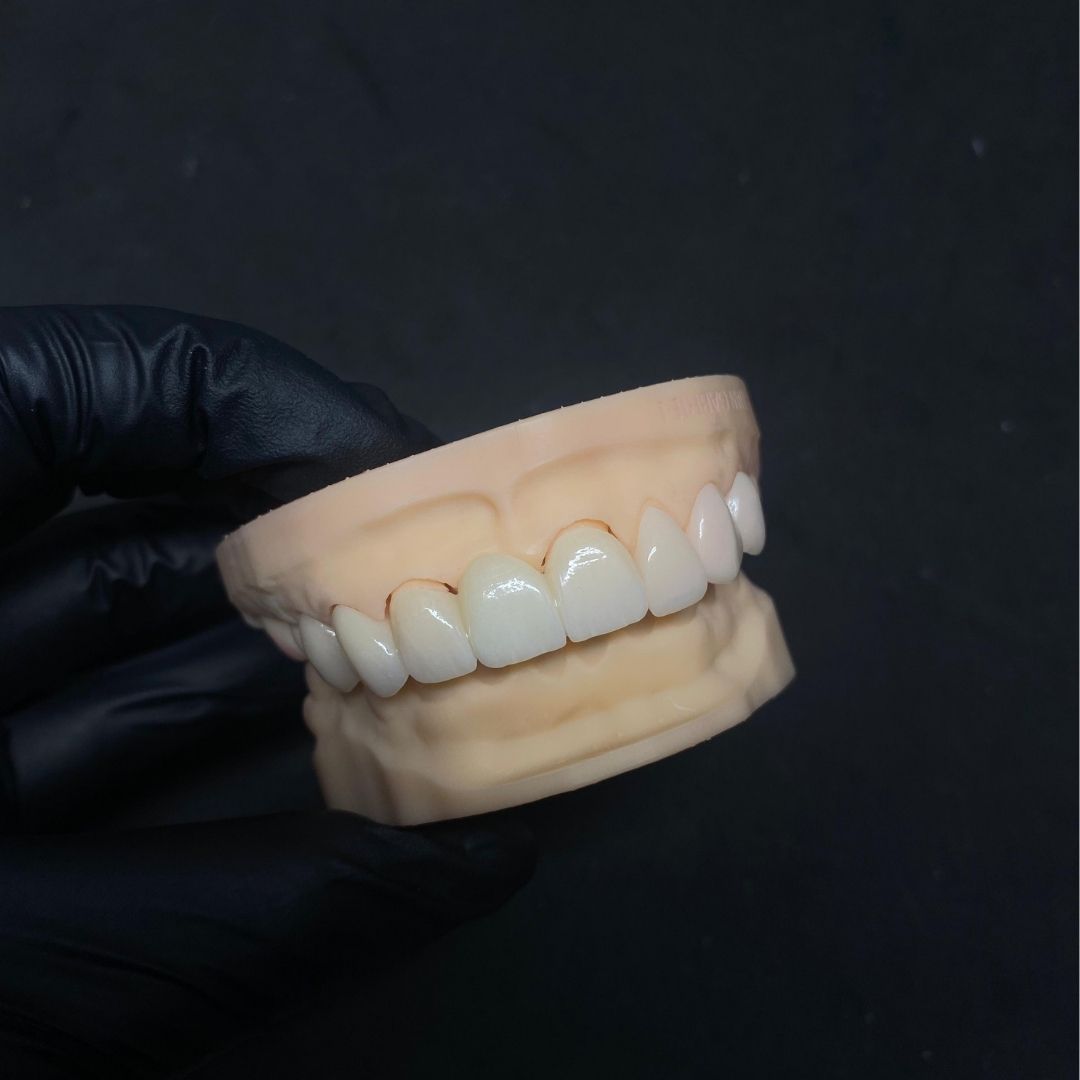 Corona en disilicato de litio (LT / HT) - Goaligner