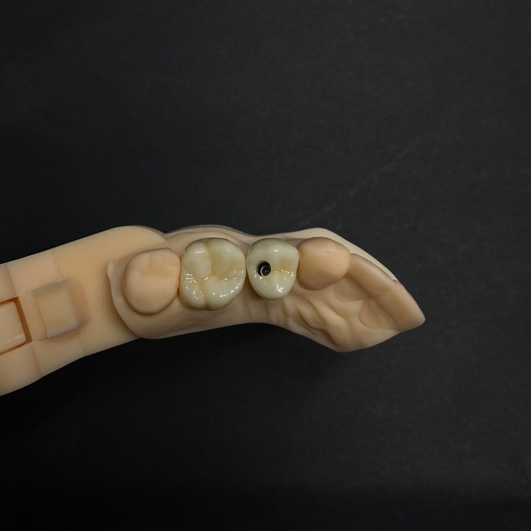 Corona sobre implante en zirconio - Goaligner