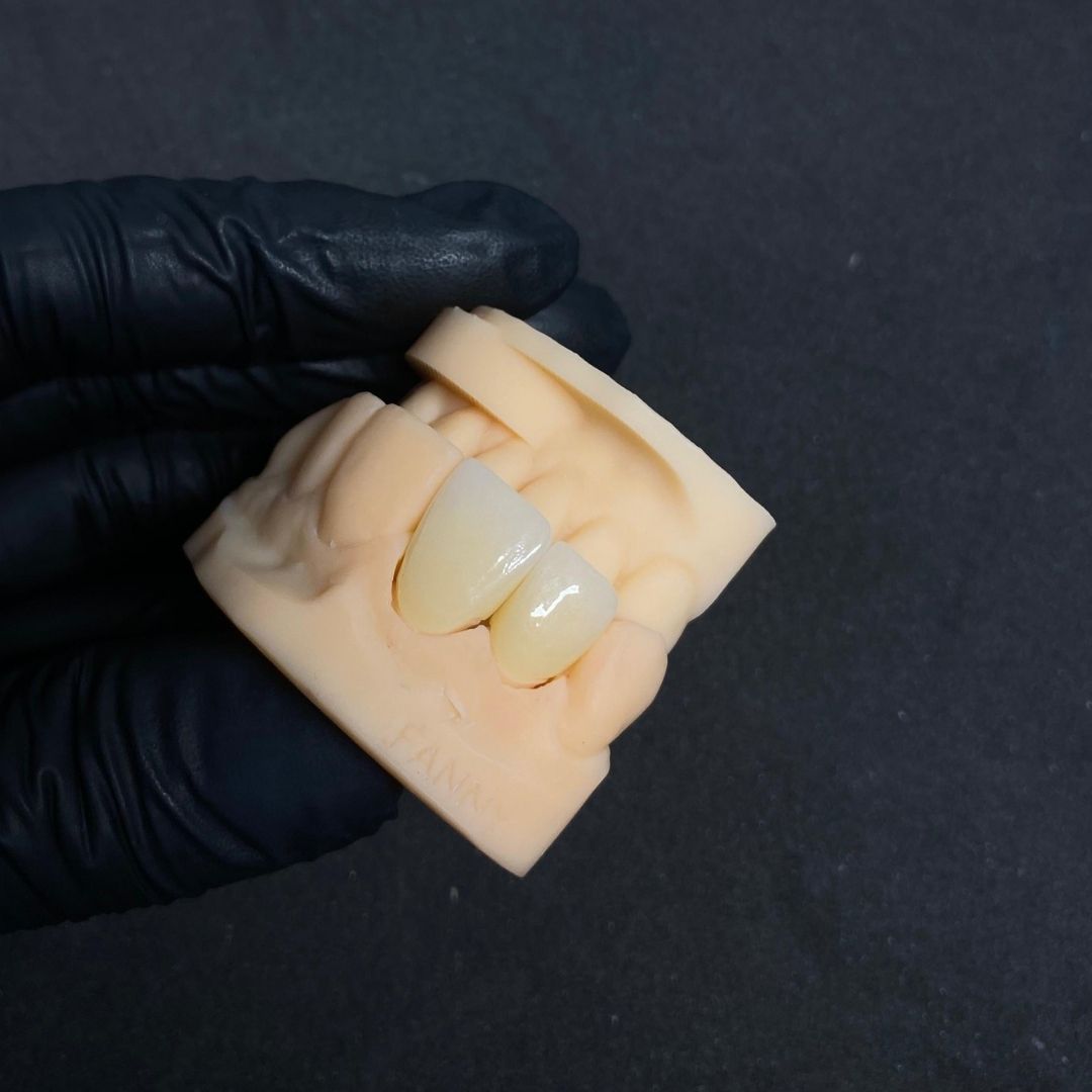Corona en zirconio multilayer - Goaligner